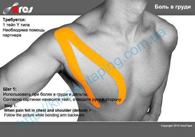 Лечение растяжения грудной мышцы методом кинезиотейпирования : Купить кинезиотейп