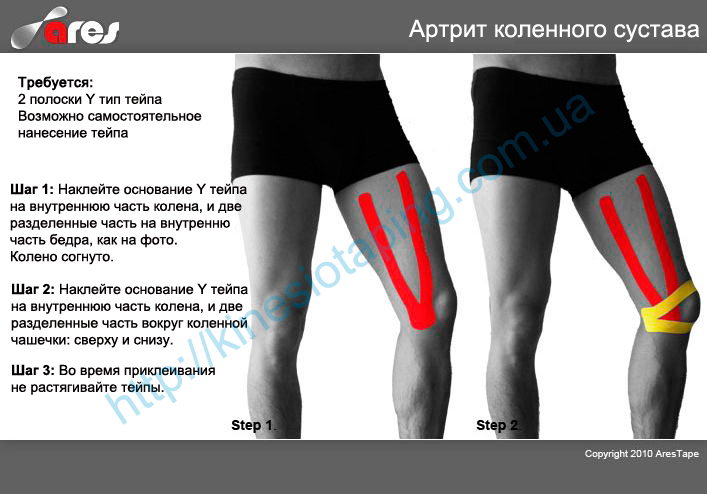 Лечение артрита коленного сустава методом кинезиотейпинга : Артрит колена лечит кинезио тейп