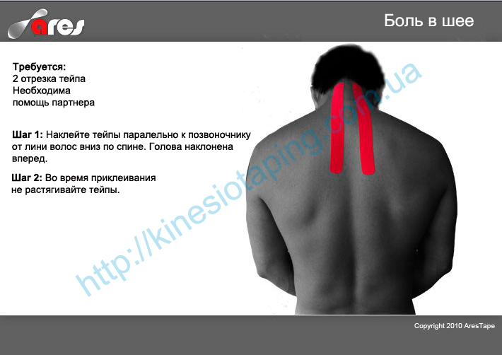 Лечение боли в шее кинезио тейпом : Купить кинезио тейп в Харькове