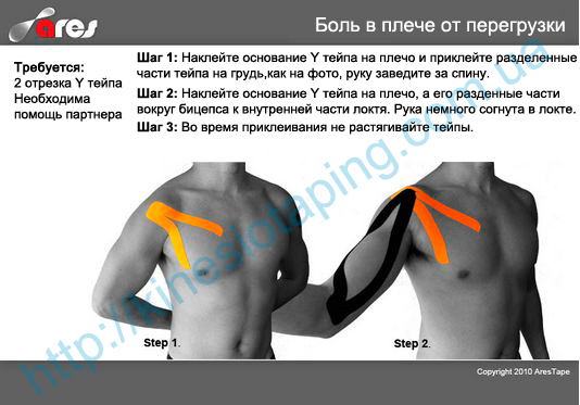 Лечения боли плеча методом кинезиотепирования : Купить кинезио тейп в Днепропетровске